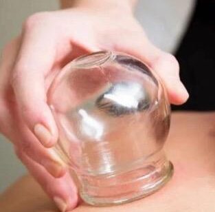 Cupping